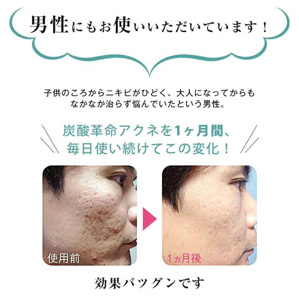 Tansan Kakumei Acne Carbonic Acid Face Treatment 1 Set - Image 4